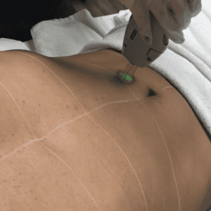 Belly Laser Hair Removal
