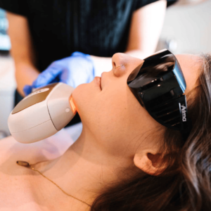 Chin Laser Hair Removal