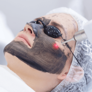 Full Face Carbon Laser