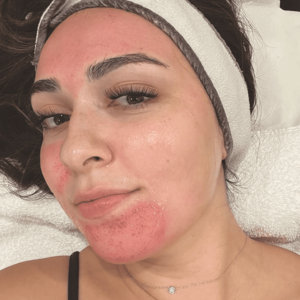 Microneedling +  Hydrafacial