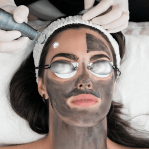 Face + Neck Carbon Laser