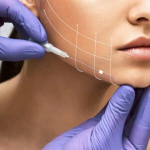 PCL COGs (Fish Bone Threads)