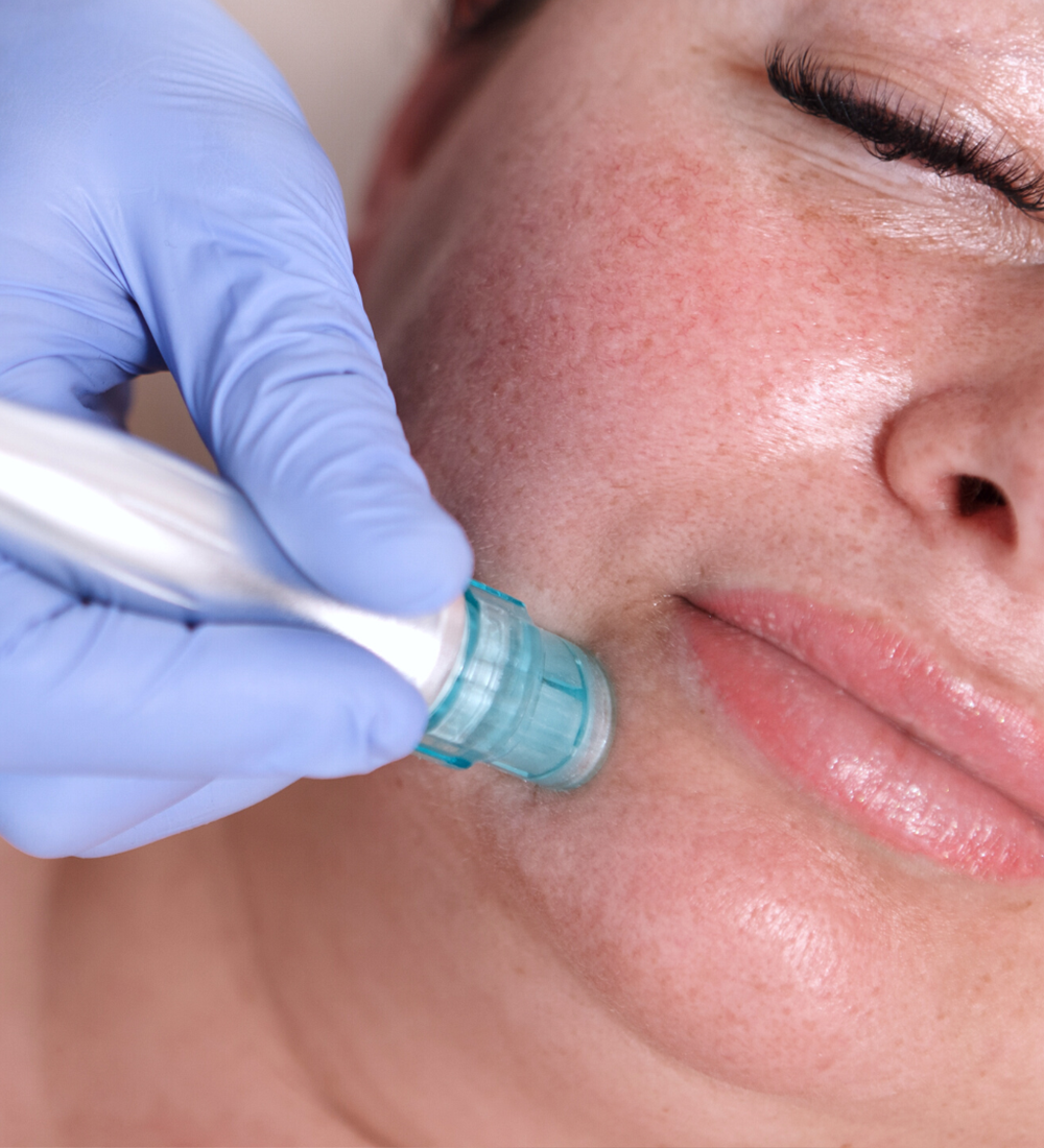 microneedling